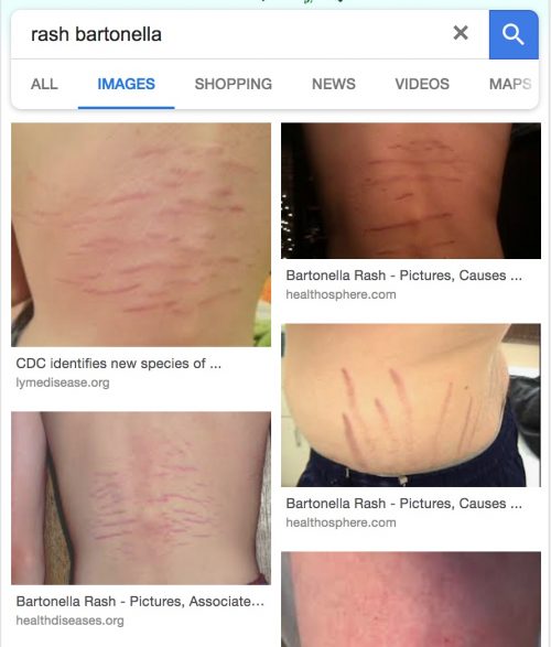 likely-fake-bartonella-rash-lymescience