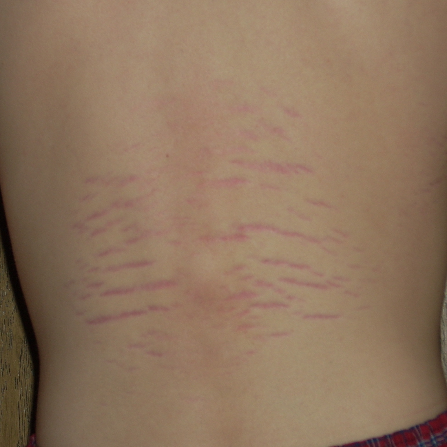Stretch Marks On Back Of Teenager Pictures Pic Side