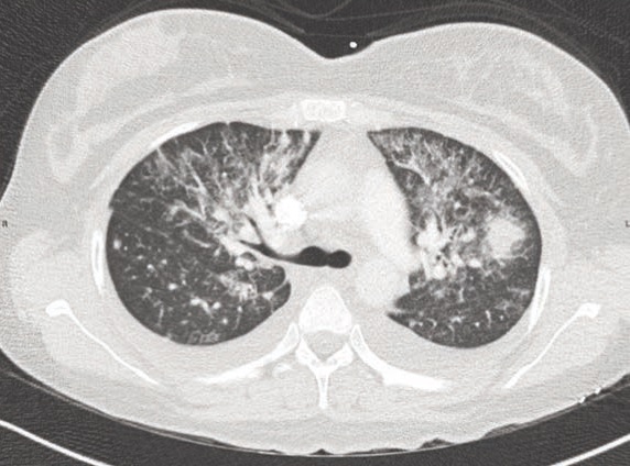 Figure 1. Computed axial tomography of the chest performed with intravenous contrast showing bilateral nodular opacifications in a bronchovascular distribution. 