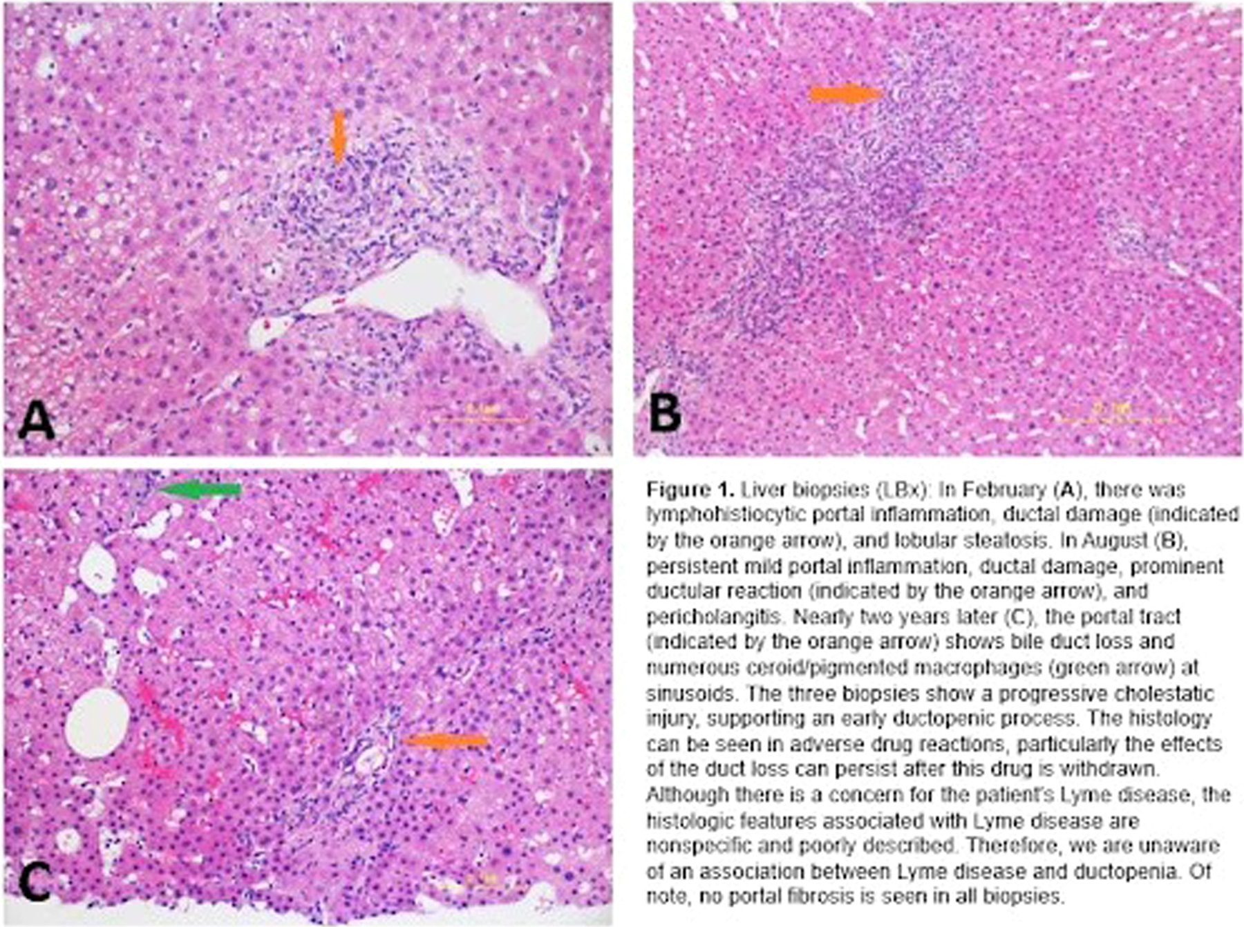 Chronic Lyme quackery causes liver damage