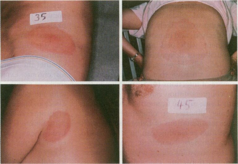 Erythema migrans